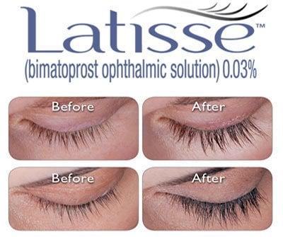 Grow your lashes! Longer, Thicker and Darker with Latisse.