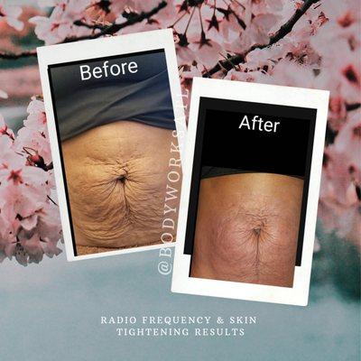 Radio Frequency Skin Tightening