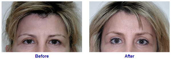 Browlift Results in Palo Alto, CA