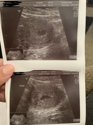 My ultrasound. I was maybe 4 weeks