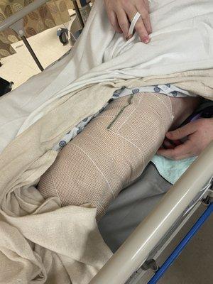 Left knee replacement surgery