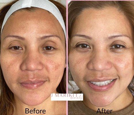 Radiant Facial and Chemical Peel