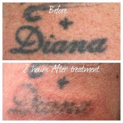 Before and After for first treatment