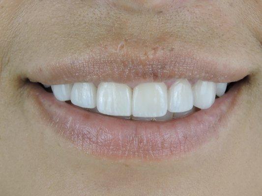 Veneers