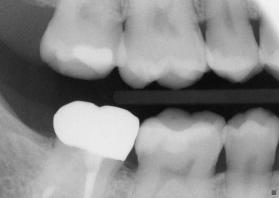 Tooth #31 (left) and #30 (right). Post op. Notice the tooth walls are flush and more inline with how natural tooth walls look.