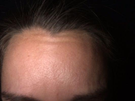 Forehead lines still show