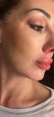 Revanesse Versa for my lips and nasal labial folds. 50 units of Botox for forehead and around eyes to soften wrinkles.