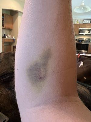 Blood draw bruise still here after 1 wk.