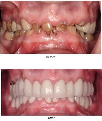 One of our full mouth reconstruction patients