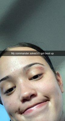 3rd day after incident, got asked by my boss if I got beat up. Not a cute look