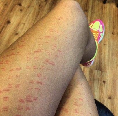 Burn marks from their laser.