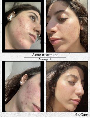 Microneedling