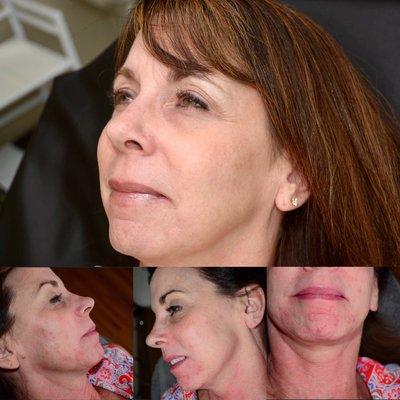 Microdermabrasion and Peels over a 4 month period.