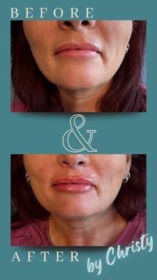 Lip enhancement with Restylane