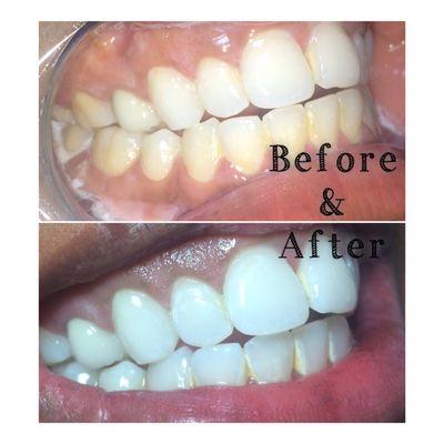 Laser Teeth Whitening