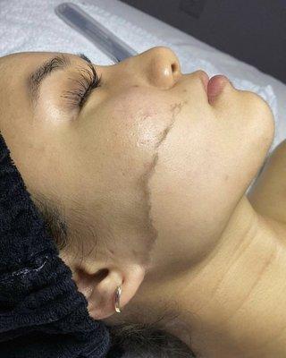 Dermaplane