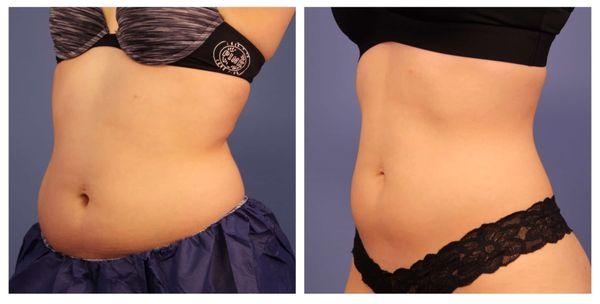 Before and After CoolSculpting