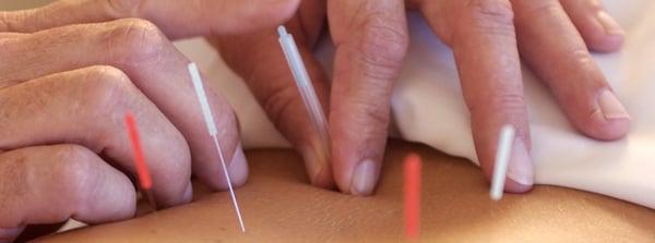 Insertion of acupuncture needles into the body.