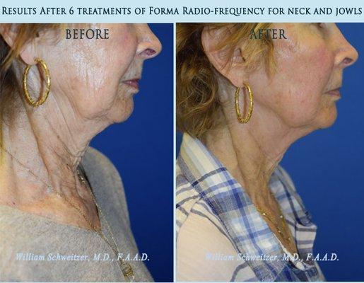 Forma radiofrequency treatment for neck