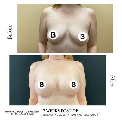 breast aug and lift