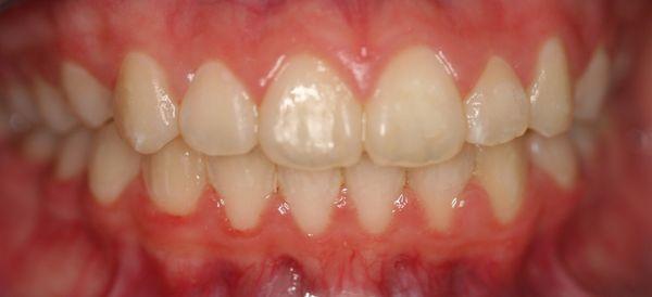 After orthodontic treatment