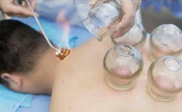 Fire cupping