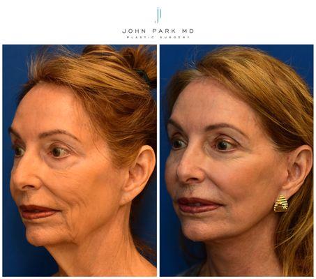 Face and Neck Lift, Upper and Lower Eyelid Blepharoplasty, Facial Fat Grafting, ZO Control Depth Peel