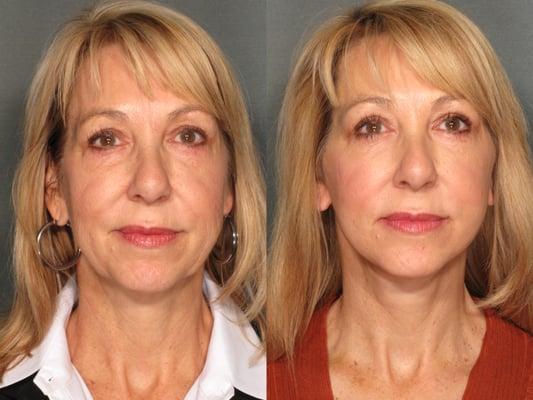 56 year old female post facelift.