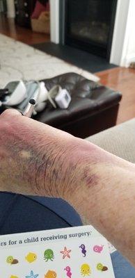 My hand after an IV they gave to me Friday night with a 215 BP.  Sent me home with a 194 BP and  Benadryl.