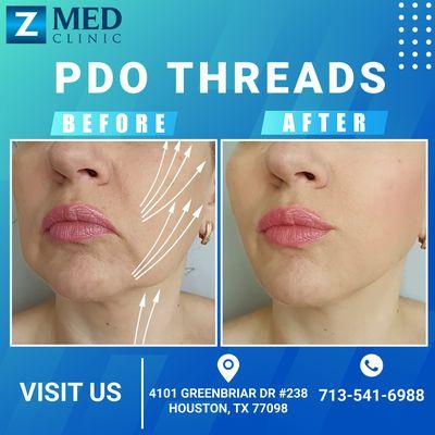 Unlock a radiant transformation with our Botox and Threads treatments at Z Med Clinic - Greenbr! 
 Rejuvenate your beauty and embrace a new