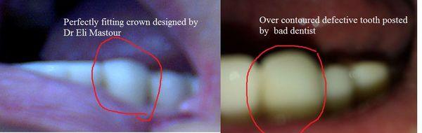 My tooth n22, and its 'journey'