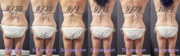 Cavitation (fat reduction) - client after 8 sessions