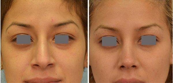 Closed rhinoplasty by Dr. Grigoryants