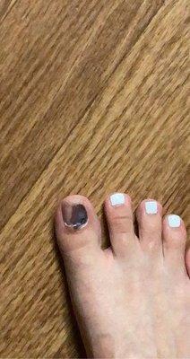 What happened to my toenail a week after getting a pedicure. Got an infection due to them having dirty equipment.