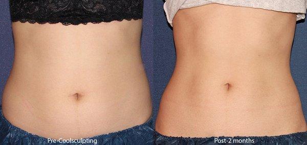 Post 2 months Coolsculpting results