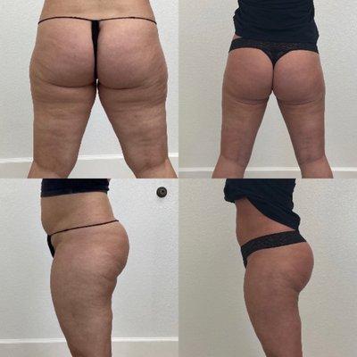 Liposuction of thighs