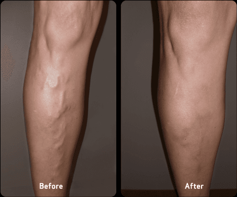 USA Vein Clinics Before and After Treatment