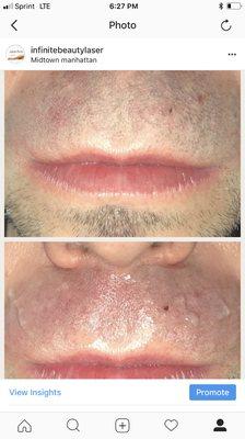 Male Laser Hair Removal #Beard #back#chest#manzillian