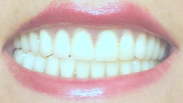 My permanent set of dentures and new smile. Praise the Lord!