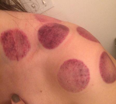 Some of the overlapping cupping marks on my shoulders. Many of these now have dark blue bruises surrounding them.