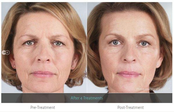 Sculptra Aesthetic for Facial Volume Restoration & Rejuvenation