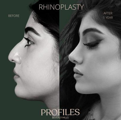 Rhinoplasty