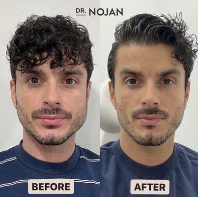 Botox before & after: one-sided jaw muscle size difference treated with Botox