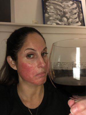 Day 3, red and itchy, but hydrating the skin every hour!!! The question is "who wore it better"? "Me or Malbec?"