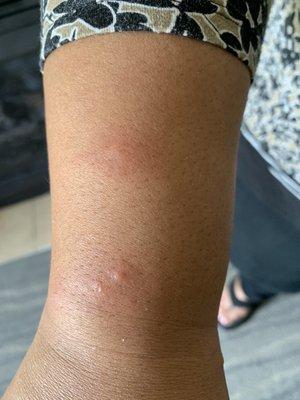 Bed bug bites