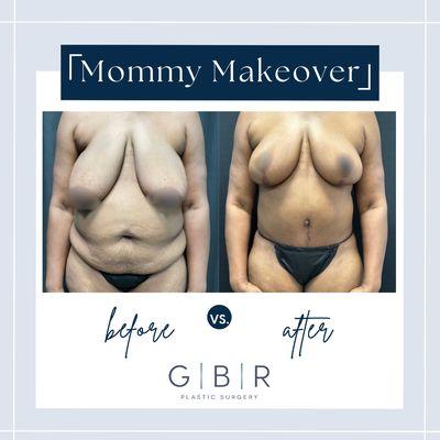 Mommy Makeover in Virginia Beach