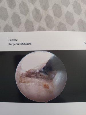 Inside my shoulder before surgery.