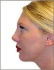 Chin Implant: After