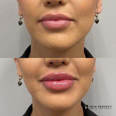 Lip Filler Before and After