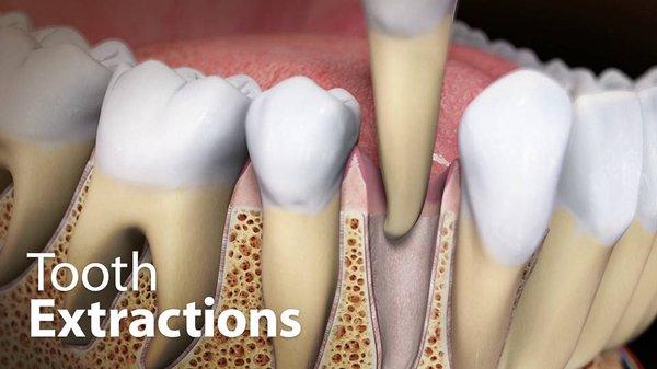 Tooth Extractions-  Please see updated blog!